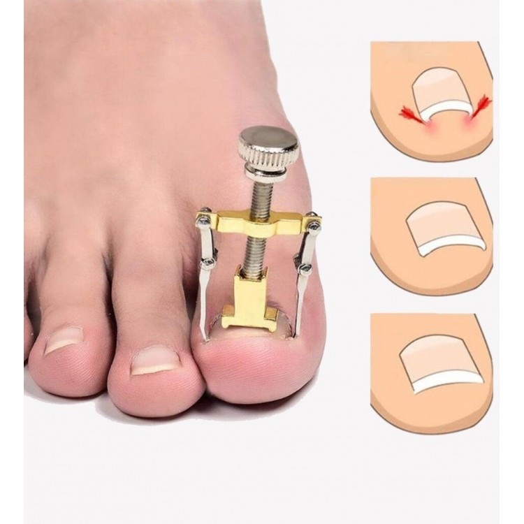 Ingrown Nail Correction Tool